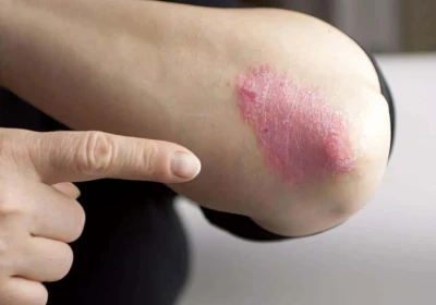 وقتی سیستم ایمنی به پوست حمله می‌کند!  پسوریازیس و راهکارهای علمی و محصولات تخصصی